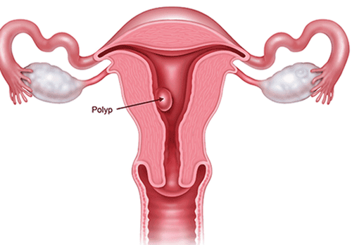 Điều trị polyp buồng tử cung như thế nào?