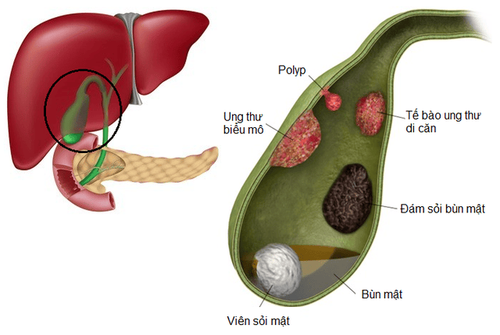 Gallbladder polyps: When to operate?