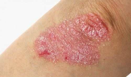 Psoriasis is difficult to cure completely