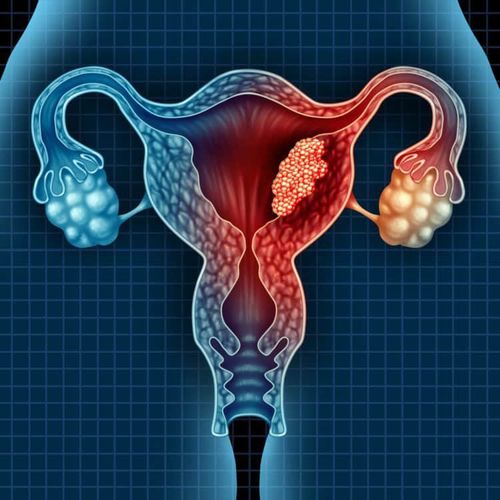 Ovarian Cysts: When to Have Surgery?