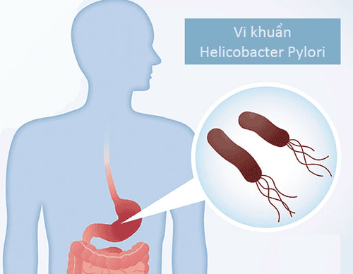 When will HP bacteria cause stomach cancer?