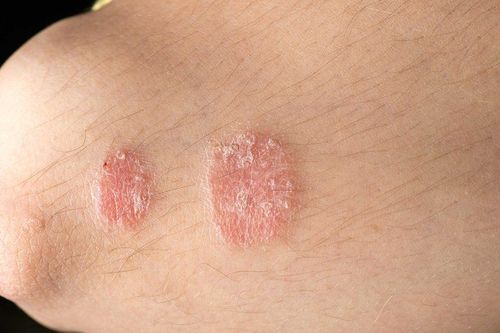 Is psoriasis contagious?