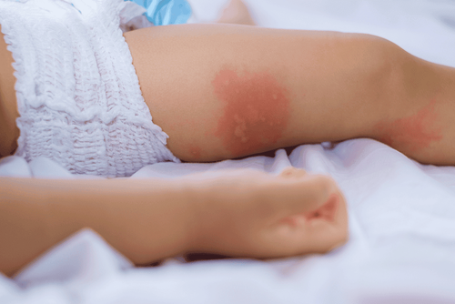 Psoriasis in babies: What you need to know