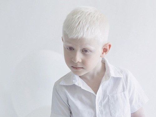 Human albinism is caused by which mutation?