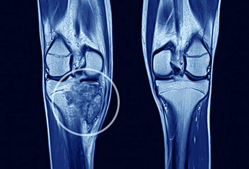 Signs of lung cancer with bone metastases - treatment prognosis