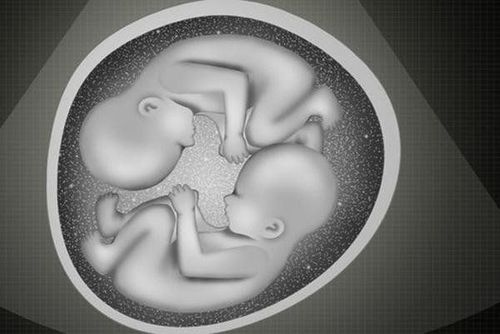 Transfusion syndrome in monochorionic, monoamniotic twins