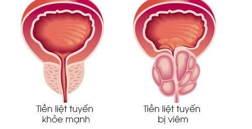 
Quan hệ tình dục ít là một trong những nguyên nhân gây ung thư tiền liệt tuyến
