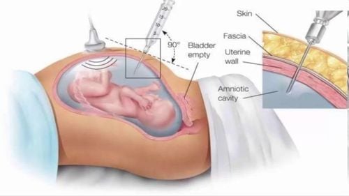 
Vị trí chọc ối dưới hướng dẫn của siêu âm
