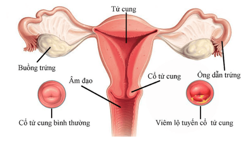 
Hình ảnh viêm lộ tuyến cổ tử cung
