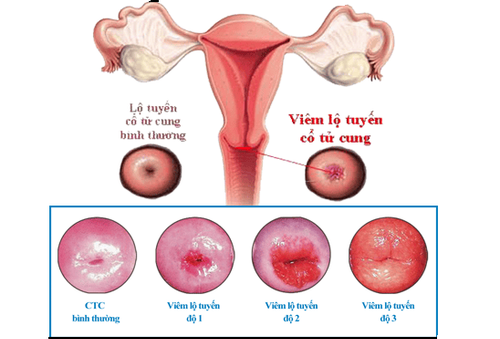 3 levels of cervical ectropion