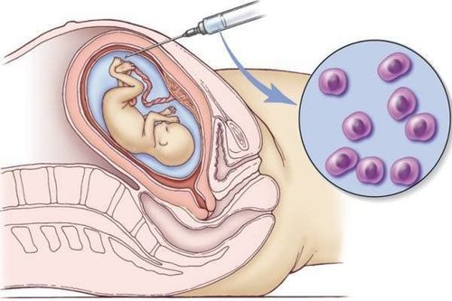 
Chọc hút ối thường được thực hiện từ tuần thứ 16 của thai kỳ trở đi
