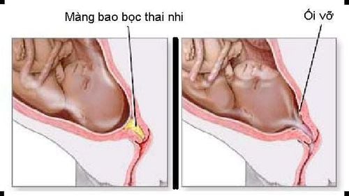 
Vỡ ối non gây ảnh hưởng đến thai nhi
