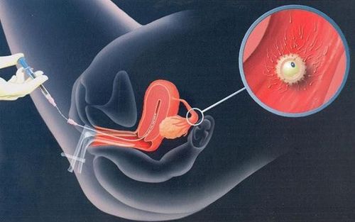 
Lọc rửa tinh trùng là một công đoạn rất quan trọng trong quá trình thực hiện phương pháp bơm tinh trùng vào buồng tử cung
