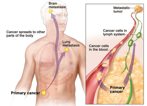 
Các tế bào ung thư sẽ đi theo đường máu hoặc đường bạch huyết để di căn tới các cơ quan khác trong cơ thể
