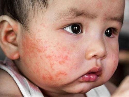 
Còn goi là bệnh Chàm trẻ em, Chàm cơ địa, Eczema thể địa
