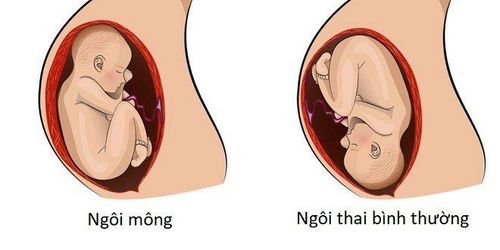 
Ngôi ngược và ngôi thai thuận
