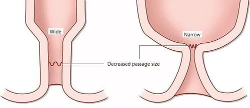 
Điều trị hẹp hậu môn bằng phẫu thuật hoặc điều trị nội khoa
