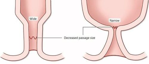 After eating, is it okay to have diarrhea and lower abdominal pain in patients with hemorrhoids surgery, when should they be re-examined?