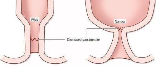 Treatment of anal stenosis by surgical or non-surgical treatment