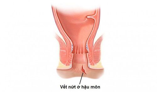 Nứt hậu môn có phải bệnh trĩ không?