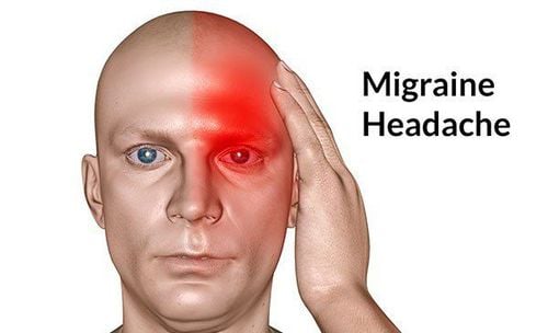 
Bệnh đau nửa đầu migraine là bệnh lý đau đầu do căn nguyên mạch máu
