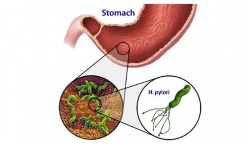 4 ways to test for HP bacteria