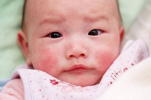 Viêm da cơ địa ở trẻ làm cho vùng da viêm khô và kích ứng, vì vậy phụ huynh cần duy trì độ ẩm cho da