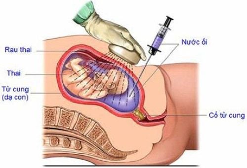 
Sinh thiết gai nhau qua màng bụng
