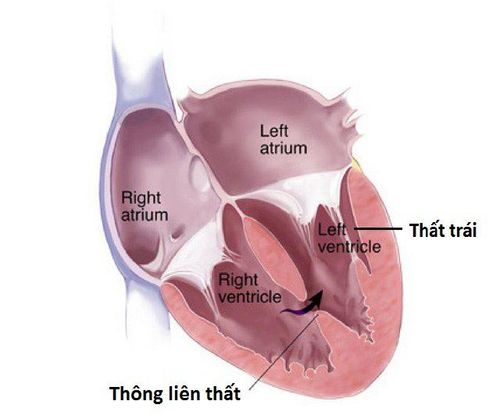 
Lỗ thông liên thất cần được đóng lại bằng phương pháp phẫu thuật
