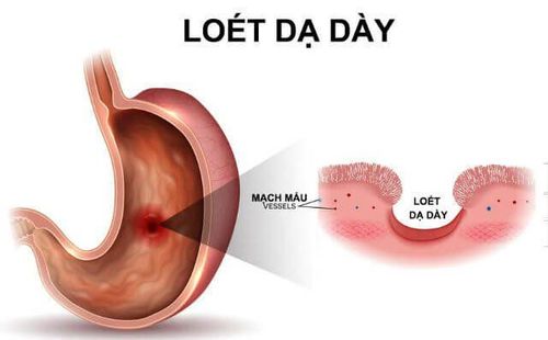 Perforation of gastric - duodenal ulcer: Dangerous complications of peptic ulcer disease