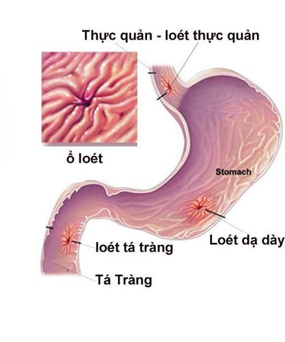 
Viêm loét dạ dày nặng có thể gây biến chứng thủng dạ dày
