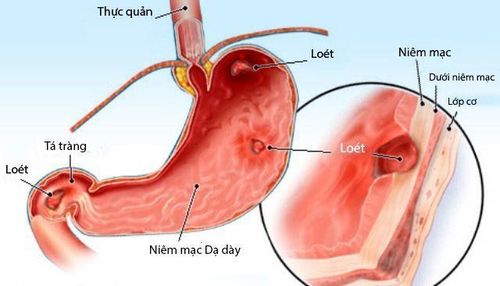 
Ổ loét gây xuất huyết tiêu hóa
