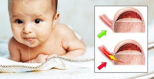 Don't Ignore Gastroesophageal Reflux in Infants