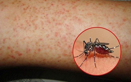 Distinguish dengue fever from common fever to detect disease early