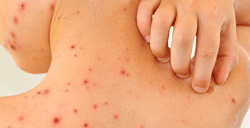 Pay attention when bathing patients with dengue fever