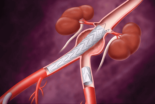 
Đặt Stent graft loại bỏ đoạn động mạch bị phình hoặc bóc tách của động mạch chủ
