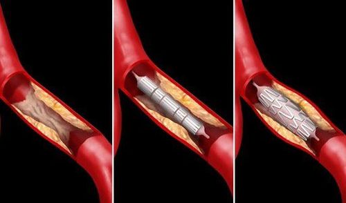 
Quá trình tiến hành đặt Stent graft.
