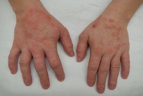 Atopic dermatitis: What you need to know