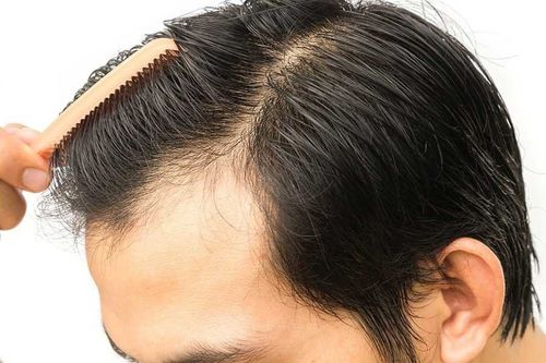 Correct understanding of hair transplant