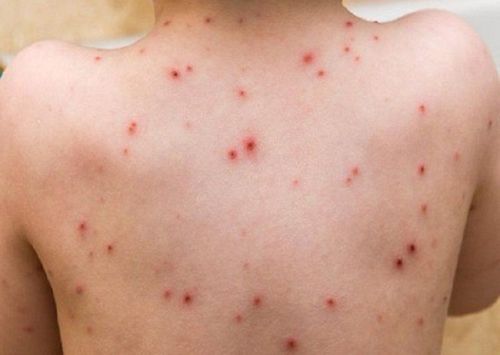 Smallpox: What you need to know