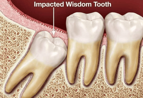 Which teeth are wisdom teeth? How many wisdom teeth does a person have?
