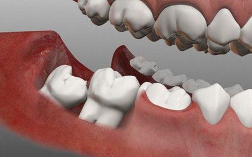 
Răng khôn là chiếc răng mọc muộn nhất trong hàm răng và chỉ phát triển khi ở độ tuổi trưởng thành
