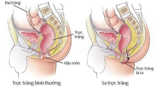 
Sa trực tràng không gây biến chứng nguy hiểm nhưng gây ra nhiều bất tiện cho người bệnh
