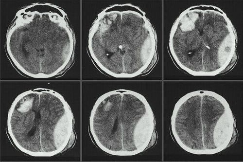 
Hình ảnh từ chụp cắt lớp vi tính sọ não
