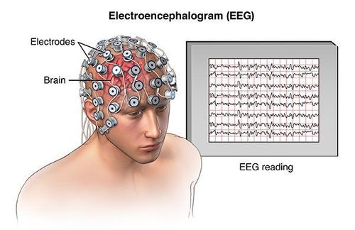 
Điện não đồ chẩn đoán bệnh đau đầu
