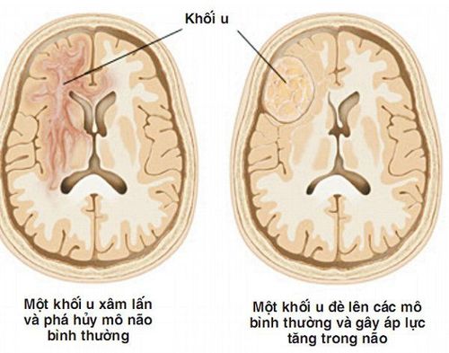 
Hình ảnh khối u não
