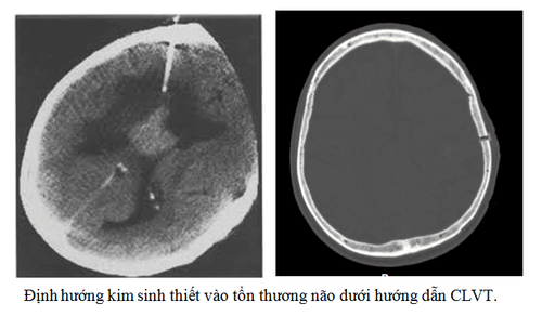 Manual brain tumor biopsy technique under the guidance of computed tomography