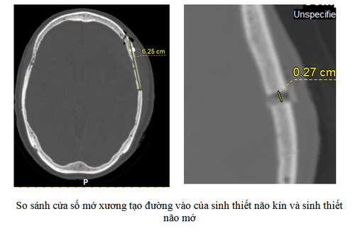 Manual brain tumor biopsy technique under the guidance of computed tomography