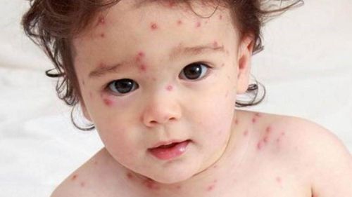 Signs and treatment of smallpox in children