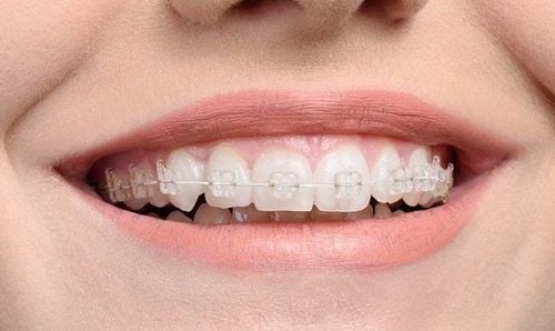 Cases of misaligned teeth need to go to the dentist